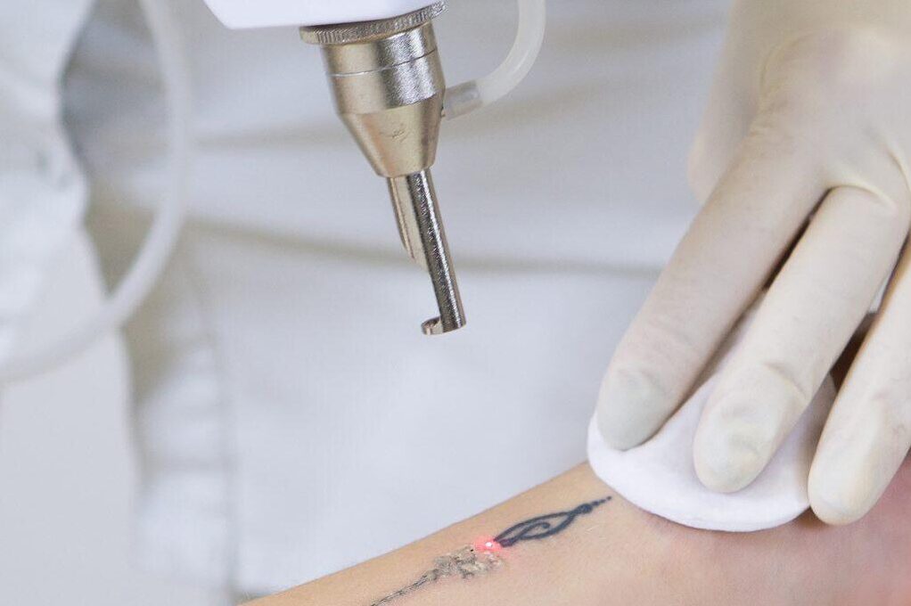 Laser Tattoo Removal